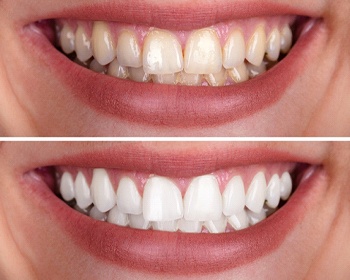 Virtual Smile Design Lincoln | Dentist Lincoln | Pioneer Greens Dentistry