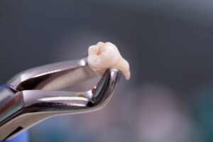 dental pliers holding an extracted tooth