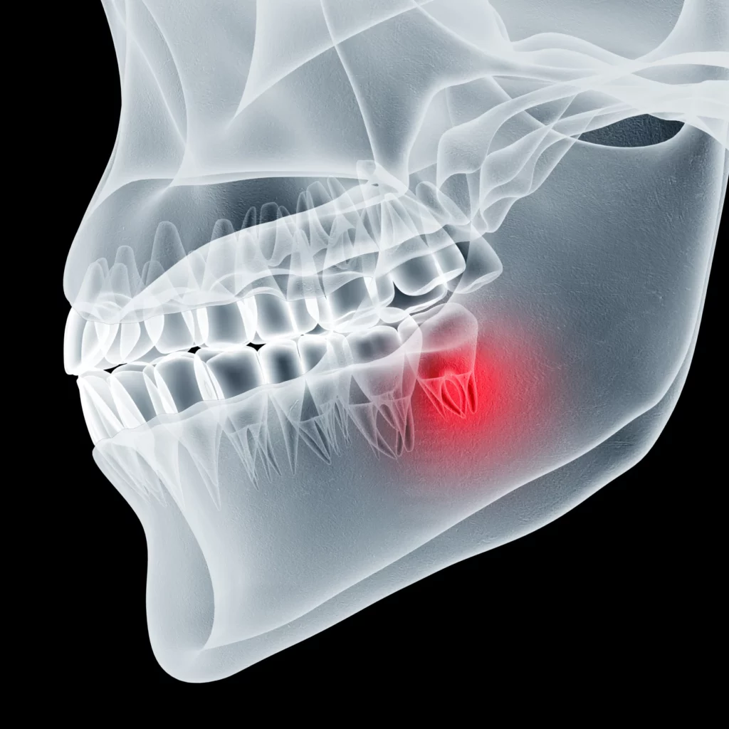 wisdom teeth removal in Lincoln, NE