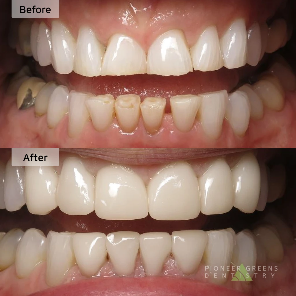 dental crowns before and after | same-day crowns in Lincoln, NE