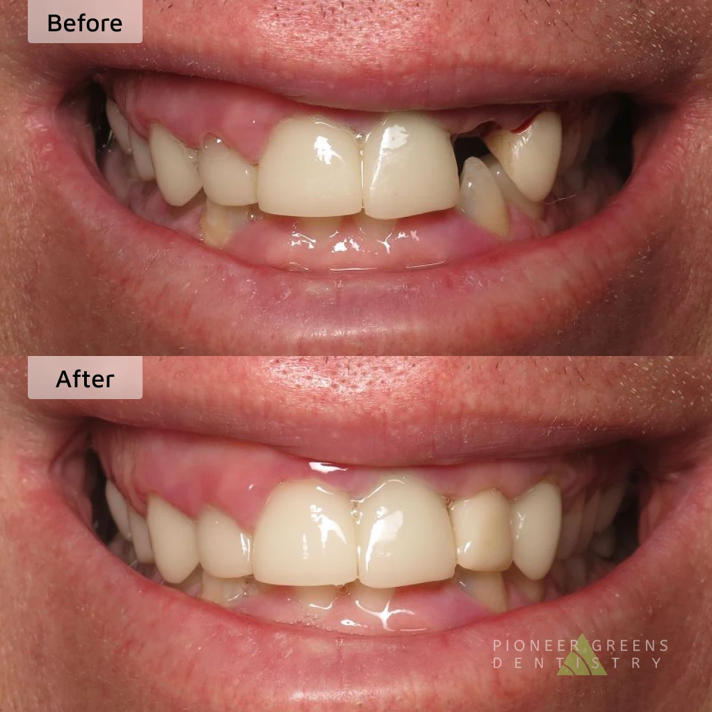 Before and after dental implant