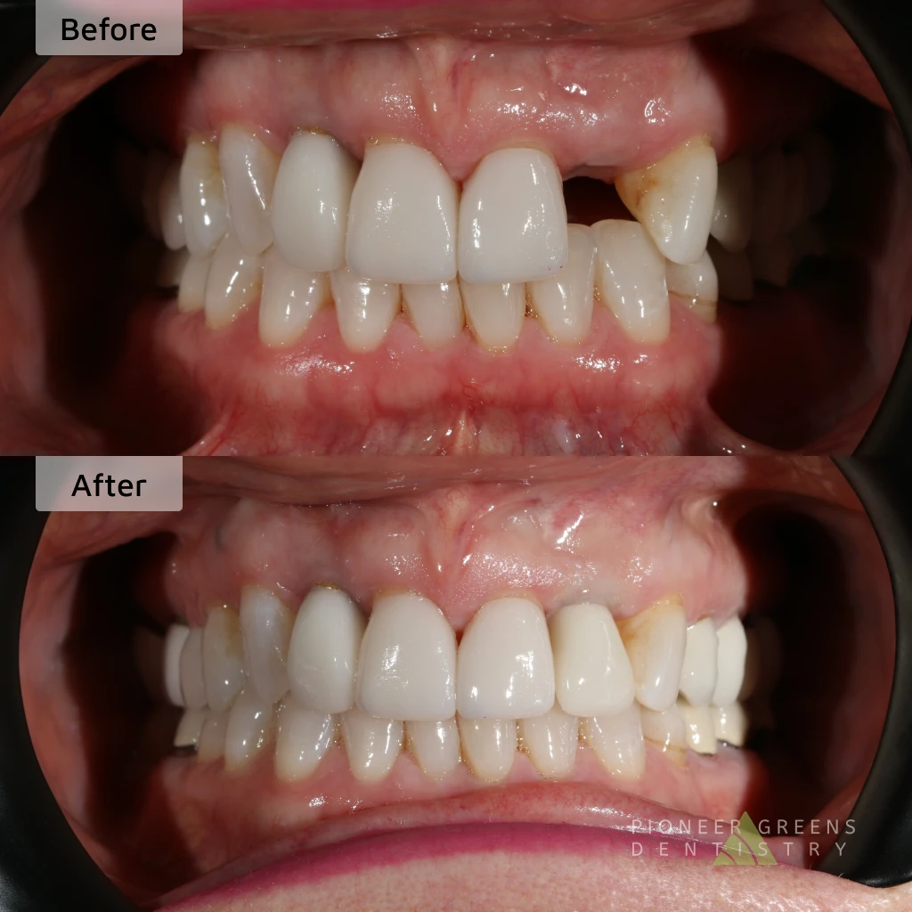 Before and after a single tooth dental implant in Lincoln, Nebraska at Pioneer Greens Dentistry