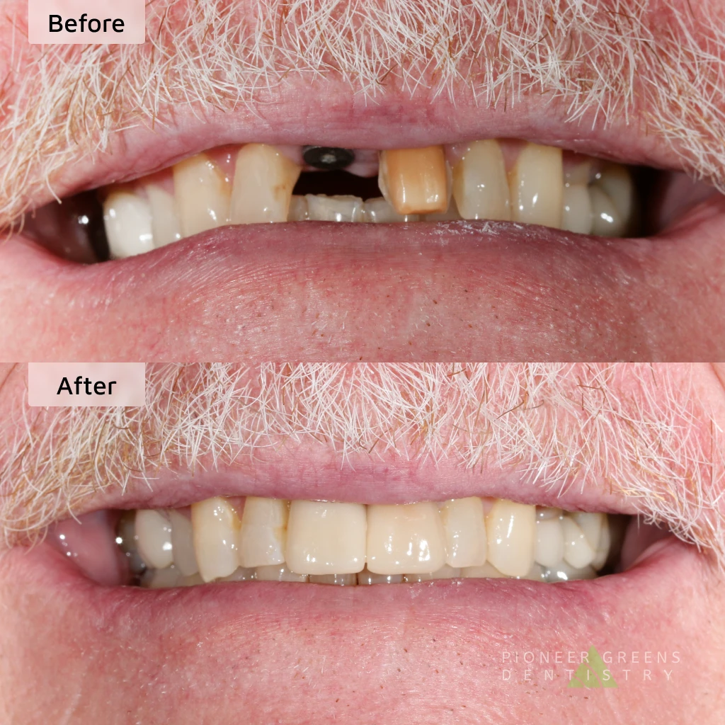 Before and after dental implants in Lincoln, Nebraska at Pioneer Greens Dentistry