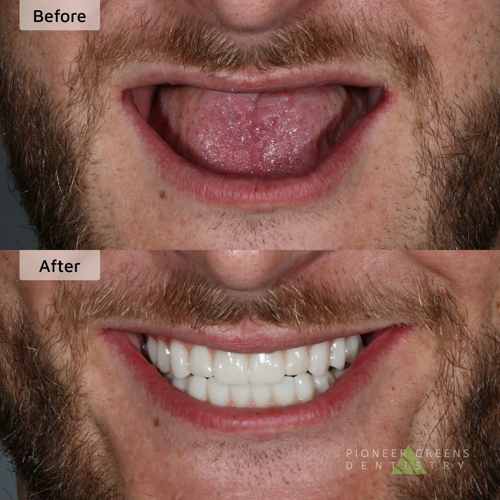 Before and after full mouth dental implants in Lincoln, Nebraska at Pioneer Greens Dentistry